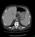 Acute renal failure post IV contrast injection- CT findings (Radiopaedia 47815-52557 Axial non-contrast 18).jpg