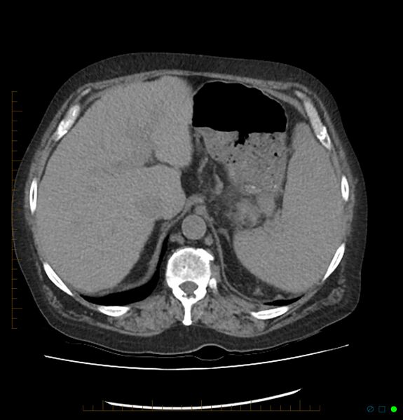 File:Acute renal failure post IV contrast injection- CT findings (Radiopaedia 47815-52557 Axial non-contrast 18).jpg