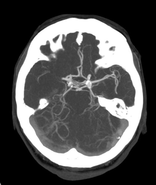 File:Acute right MCA M1 occlusion (Radiopaedia 62268-70454 Axial Phase 1 19).jpg