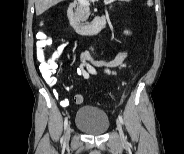 File:Acute sigmoid colon diverticulitis (Radiopaedia 55507-61976 Coronal C+ portal venous phase 68).jpg