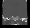 Acute sinusitis (Radiopaedia 23161-23215 Coronal bone window 59).jpg