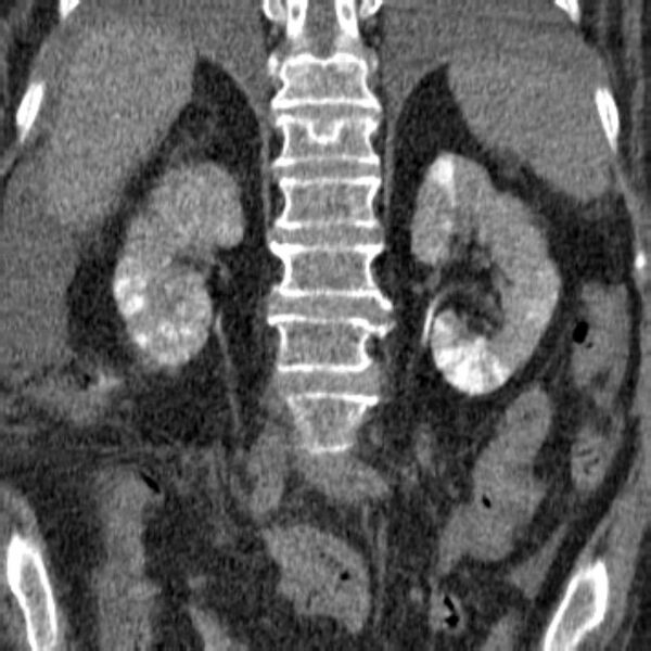 File:Acute tubular necrosis (Radiopaedia 28077-28334 Coronal non-contrast 14).jpg