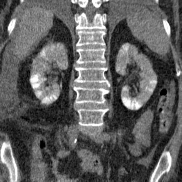 File:Acute tubular necrosis (Radiopaedia 28077-28334 Coronal non-contrast 16).jpg