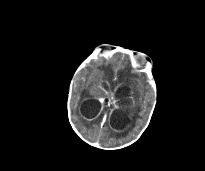 File:Acute ventriculitis (Radiopaedia 57502-64459 Axial +contrast 10).jpg