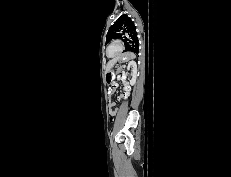 File:Addison disease (Radiopaedia 49318-54412 Sagittal C+ portal venous phase 22).jpg