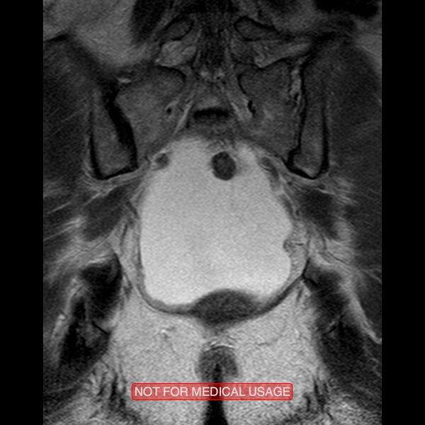 File:Adenocarcinoma of the cervix (Radiopaedia 28373-28615 Coronal T2 16).jpg