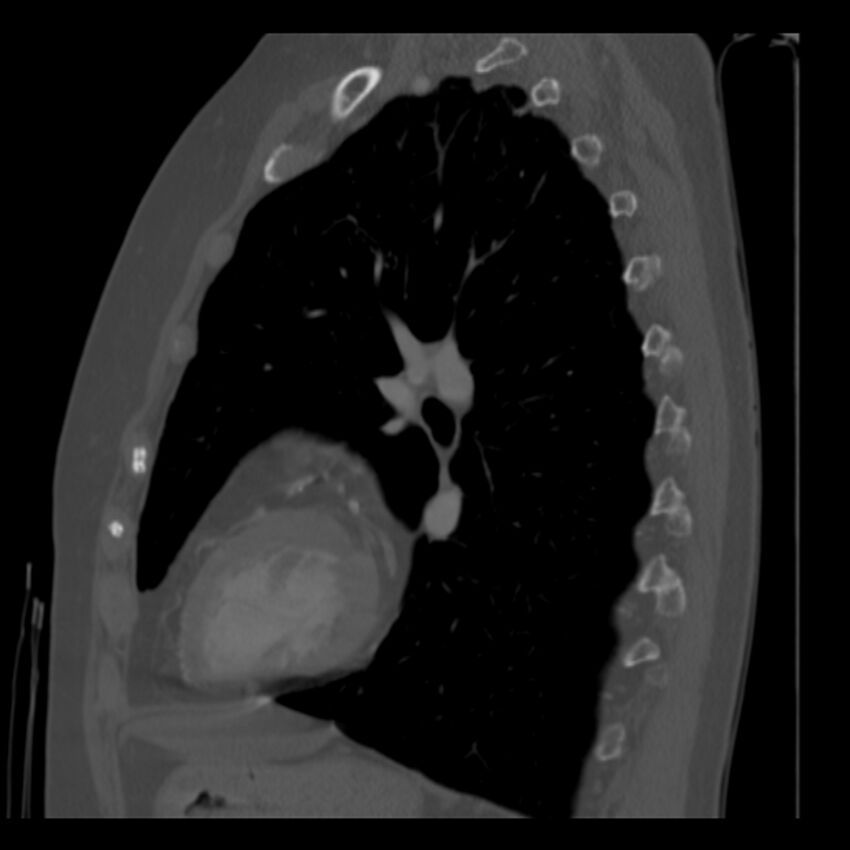 Adenocarcinoma of the lung (Radiopaedia 41015-43755 Sagittal bone window 68).jpg