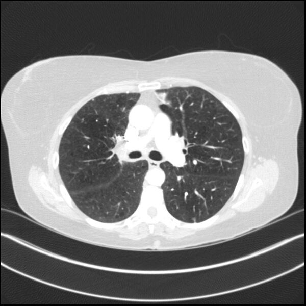 File:Adenocarcinoma of the lung (Radiopaedia 44205-47803 Axial lung window 41).jpg