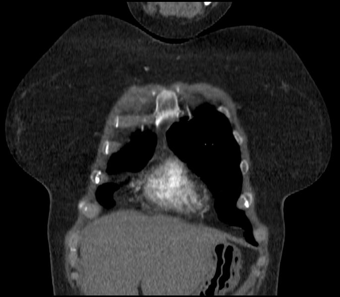 File:Adenocarcinoma of the lung (Radiopaedia 44205-47803 Coronal C+ portal venous phase 12).jpg