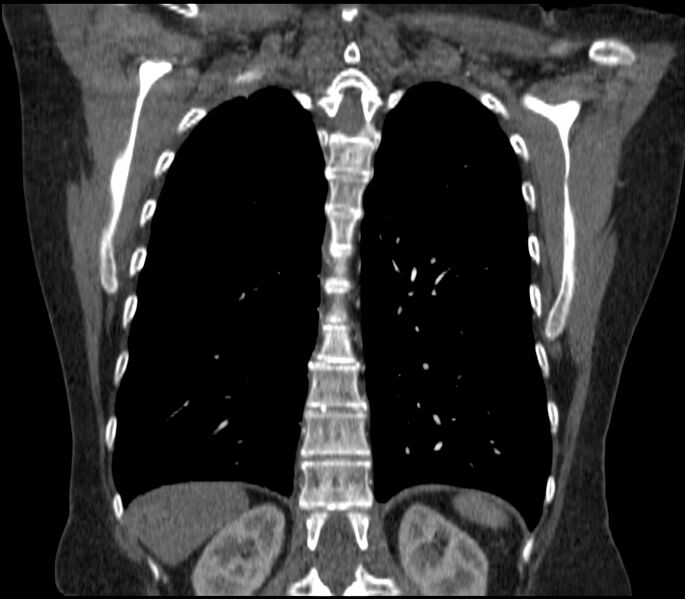 File:Adenocarcinoma of the lung (Radiopaedia 44205-47803 Coronal C+ portal venous phase 71).jpg