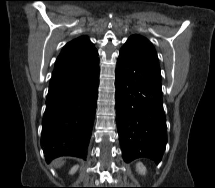 File:Adenocarcinoma of the lung (Radiopaedia 44205-47803 Coronal C+ portal venous phase 78).jpg