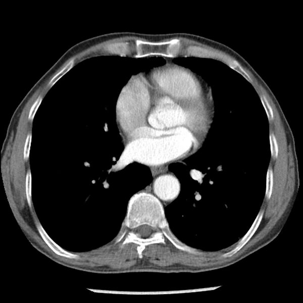 File:Adenocarcinoma of the lung - micropapillary predominant (Radiopaedia 42446-45563 Axial C+ portal venous phase 45).jpg