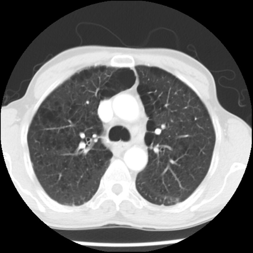 Adenocarcinoma of the lung - micropapillary predominant (Radiopaedia 42446-45563 Axial lung window 24).jpg