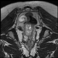 Adenoma malignum of the cervix (Radiopaedia 24460-24765 Coronal T2 25).jpg