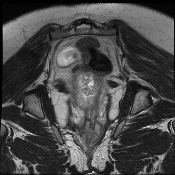 File:Adenoma malignum of the cervix (Radiopaedia 24460-24765 Coronal T2 25).jpg