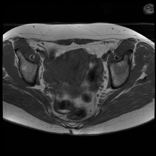 File:Adenoma malignum of the cervix (Radiopaedia 24460-24765 T1 10).jpg