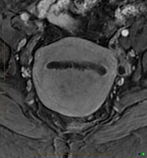 File:Adenomyosis uterus with hematometra (Radiopaedia 45779-50011 Axial T1 C+ fat sat 26).jpg