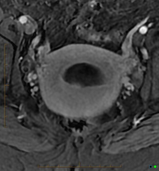 File:Adenomyosis uterus with hematometra (Radiopaedia 45779-50011 Axial T1 C+ fat sat 38).jpg