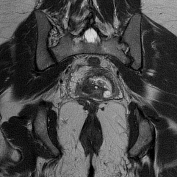 File:Adenomyosis within a septate uterus (Radiopaedia 69963-79981 Coronal T2 25).jpg