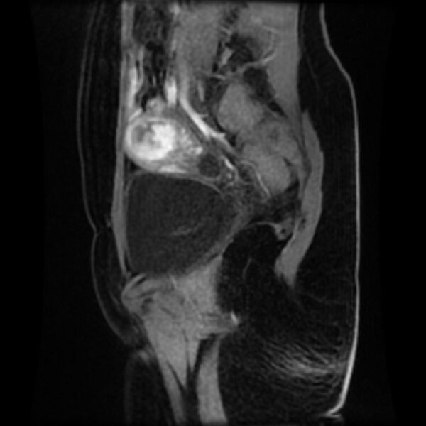 File:Adenomyosis within a septate uterus (Radiopaedia 69963-79981 Sagittal LAVA-Dyn 8).jpg