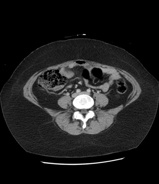File:Adrenal cortical carcinoma with IVC invasion and thrombosis (Radiopaedia 34307-35597 Axial C+ portal venous phase 57).jpg