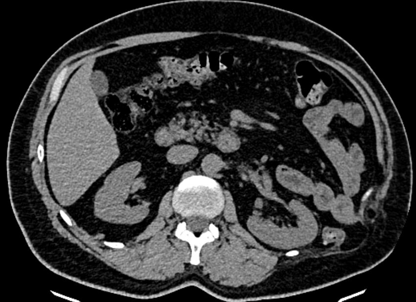 Adrenal metastases (Radiopaedia 73082-83791 Axial non-contrast 75).jpg