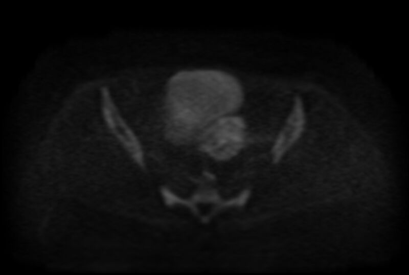 File:Adult granulosa cell tumor of the ovary (Radiopaedia 71581-81950 Axial DWI 13).jpg