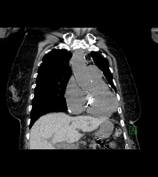 File:Amiodarone deposition in the liver (Radiopaedia 77587-89780 Coronal non-contrast 29).jpg