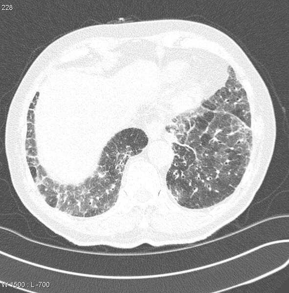 File:Amiodarone lung (Radiopaedia 6539-7851 Axial lung window 22).jpg