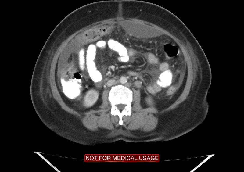 File:Amoebic enterocolitis with liver abscess (Radiopaedia 35100-36609 A 42).jpg