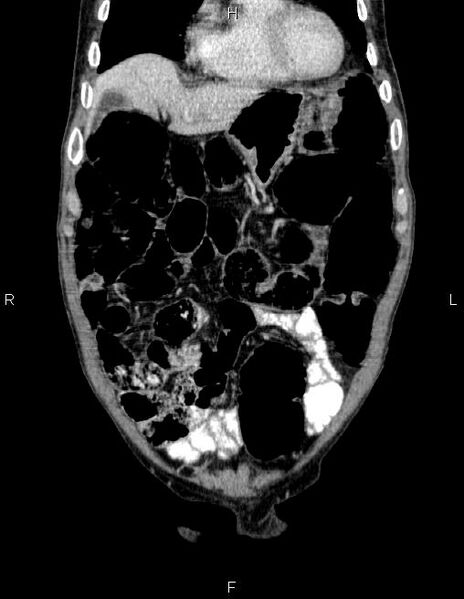 File:Ampullary adenocarcinoma (Radiopaedia 86093-102032 C 14).jpg