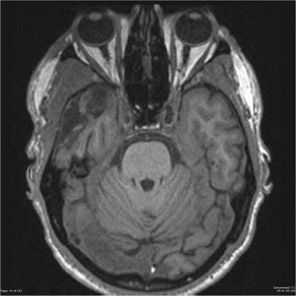 File:Anaplastic meningioma with recurrence (Radiopaedia 34452-35788 Axial T1 39).jpg
