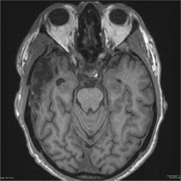 File:Anaplastic meningioma with recurrence (Radiopaedia 34452-35788 Axial T1 46).jpg