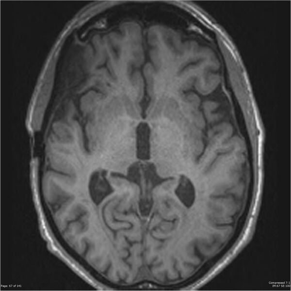 File:Anaplastic meningioma with recurrence (Radiopaedia 34452-35788 Axial T1 65).jpg