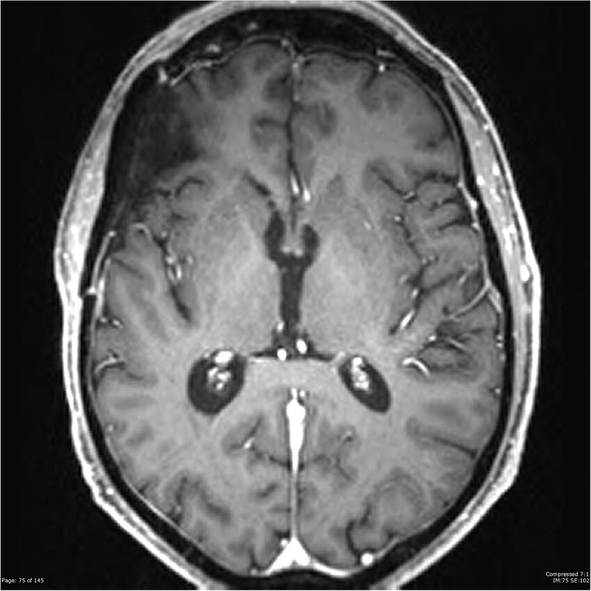 Anaplastic meningioma with recurrence (Radiopaedia 34452-35788 Axial T1 C+ 75).jpg