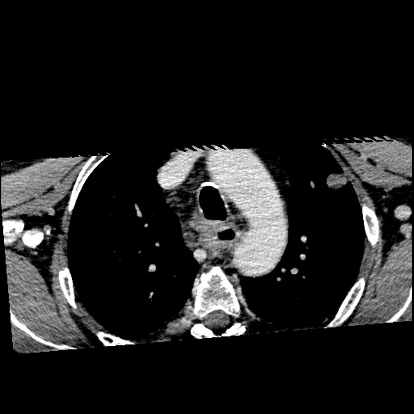 Anaplastic thyroid carcinoma (Radiopaedia 79087-92034 B 6).jpg