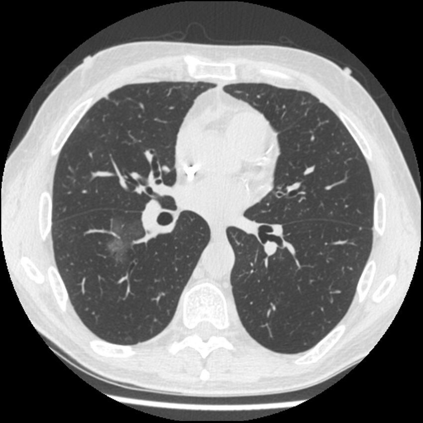 Angioinvasive aspergillosis (Radiopaedia 43957-47466 Axial lung window 36).jpg