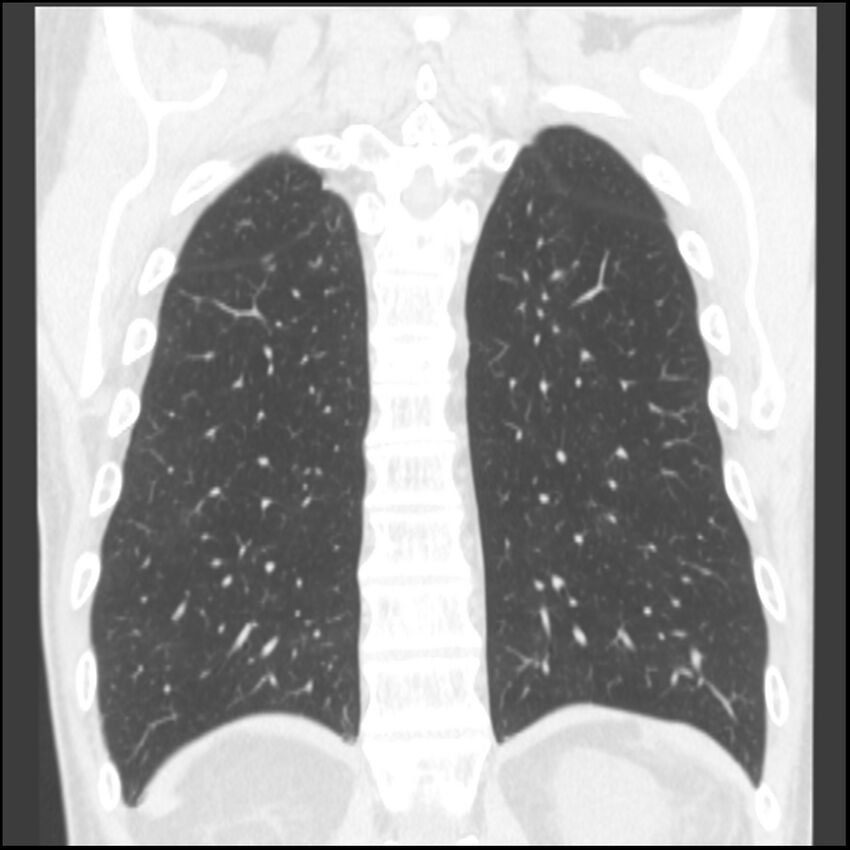 Angioinvasive aspergillosis (Radiopaedia 43957-47466 Coronal lung window 21).jpg