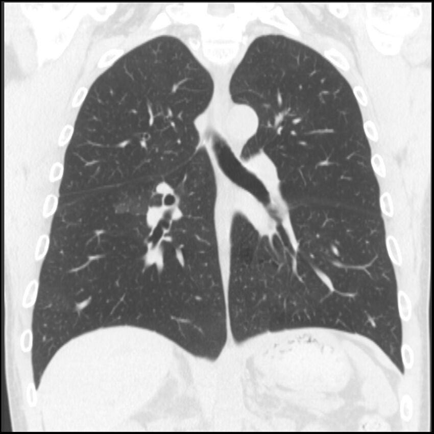 Angioinvasive aspergillosis (Radiopaedia 43957-47466 Coronal lung window 41).jpg