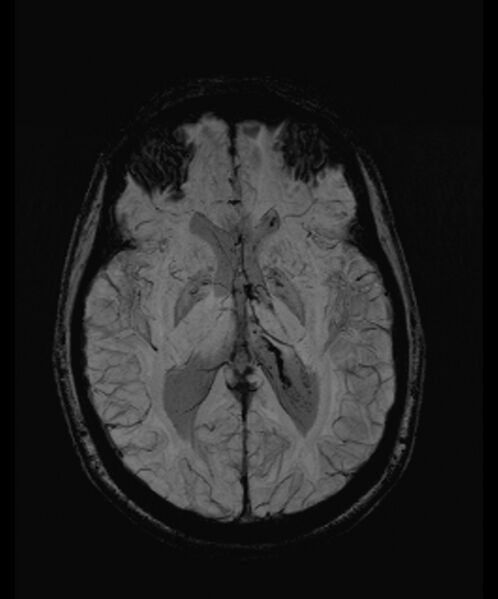 File:Angiomatous meningioma (Radiopaedia 79459-92579 E 34).jpg