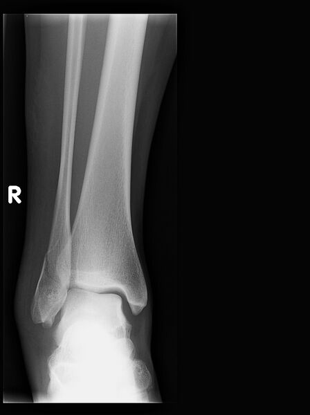 File:Ankle fracture - Weber B (Radiopaedia 46843-51371 Frontal 1).jpg