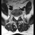 Ankylosing spondylitis with zygapophyseal arthritis (Radiopaedia 38433-40516 Axial T2 4).jpg