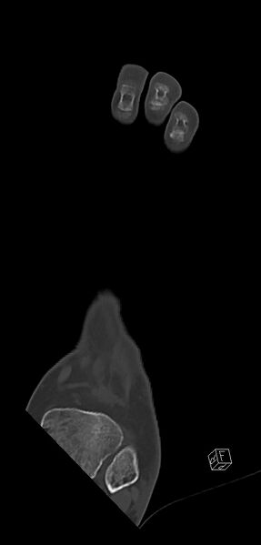 File:Anterior calcaneal process fracture (Radiopaedia 63353-71943 Coronal bone window 10).jpg