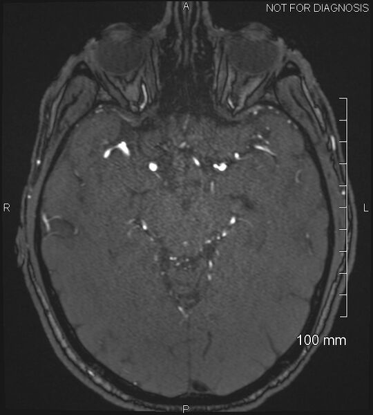 File:Anterior cerebral artery aneurysm (Radiopaedia 80683-94127 Axial MRA 100).jpg
