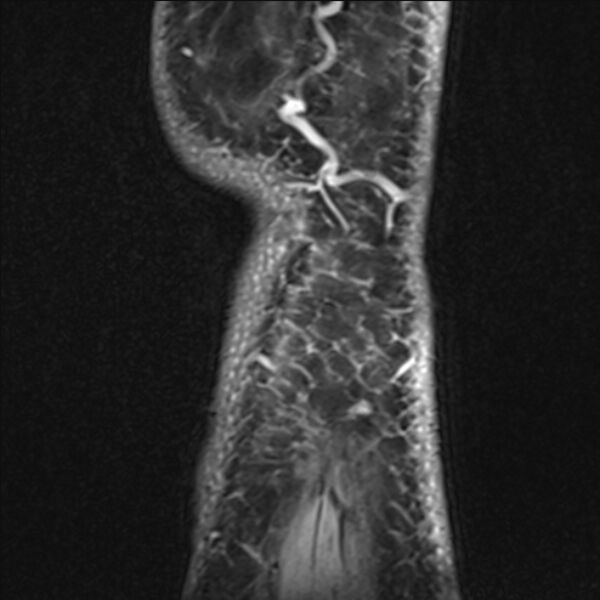 File:Anterior cruciate ligament tear - ramp lesion (Radiopaedia 71883-82322 Sagittal T1 vibe 7).jpg