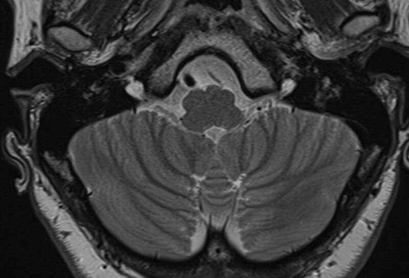 File:Anterior inferior cerebellar artery vascular loop - type III (Radiopaedia 75701).jpg