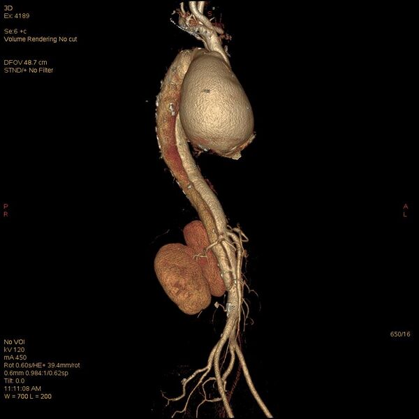 File:Aortic dissection (Radiopaedia 25350-25604 E 16).jpg