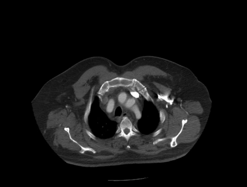 File:Aortic dissection (Radiopaedia 28802-29105 A 1).jpg