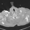 Aortic dissection - DeBakey type II (Radiopaedia 64302-73082 Axial lung window 4).png