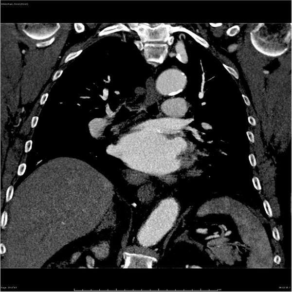 File:Aortic dissection - Stanford type A (Radiopaedia 26183-26315 A 39).jpg